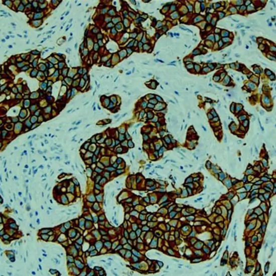 Book Immunohistochemistry HER2 Neu | Test Price In Delhi, India ...