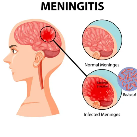 meningitis package test