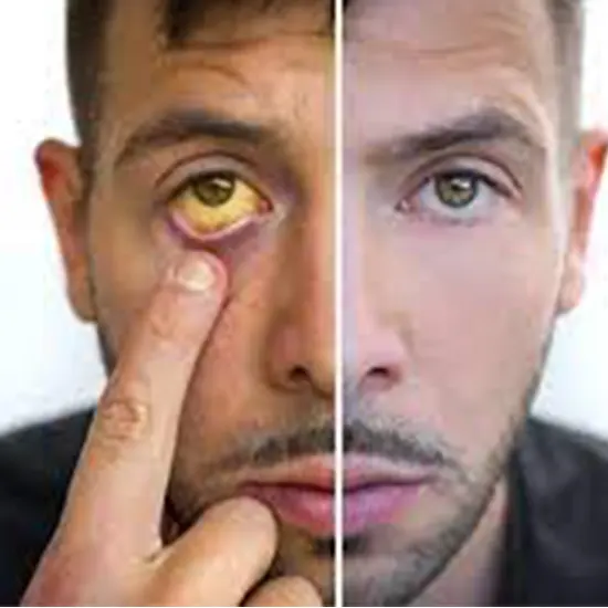 jaundice test package