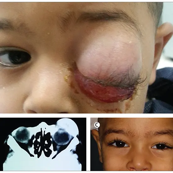 rhabdomyosarcoma test package