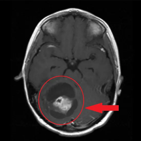 astrocytoma