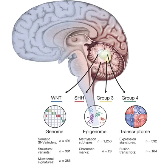 medulloblastoma
