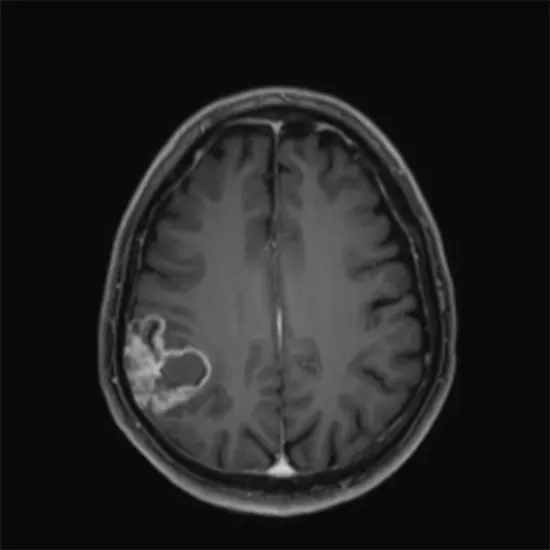 oligodendroglioma
