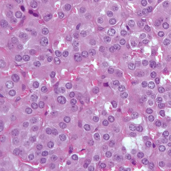 pheochromocytoma