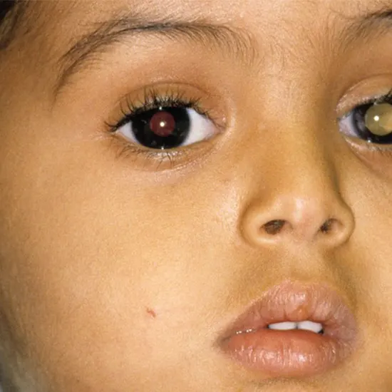 Retinoblastoma Test Price In Delhi Cost Near Me, India Ganesh
