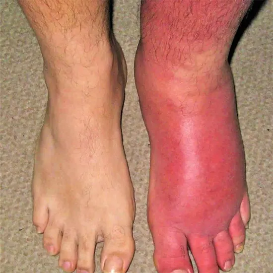 cellulitis test package