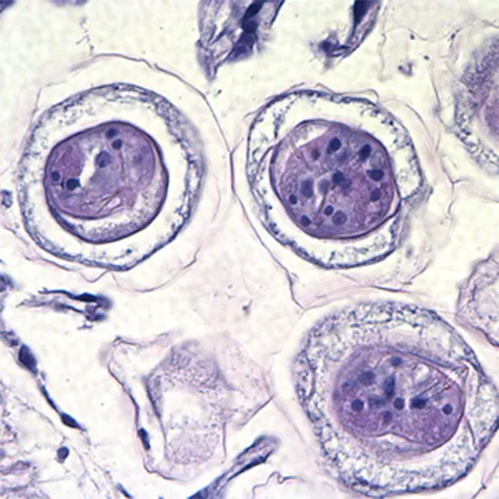 Hymenolepiasis