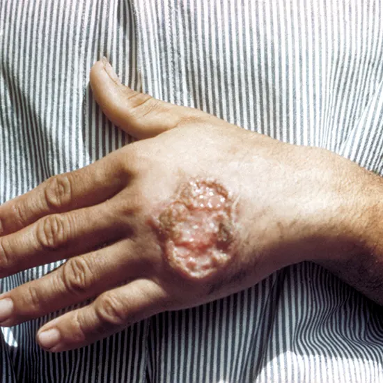 Leishmaniasis