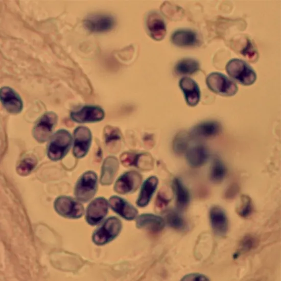 Microsporidiosis